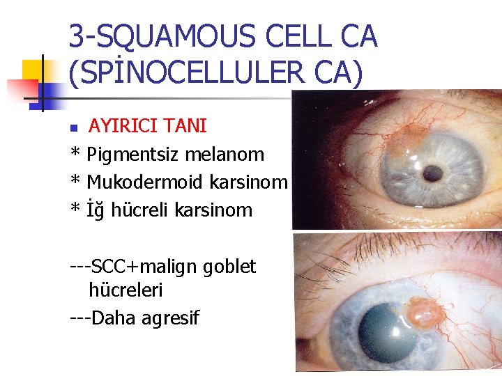 3 -SQUAMOUS CELL CA (SPİNOCELLULER CA) AYIRICI TANI * Pigmentsiz melanom * Mukodermoid karsinom 3 -SQUAMOUS CELL CA (SPİNOCELLULER CA) AYIRICI TANI * Pigmentsiz melanom * Mukodermoid karsinom