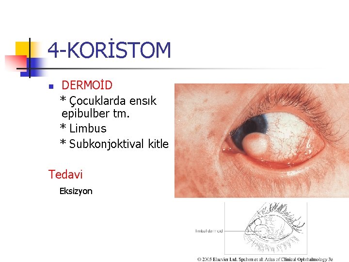 4 -KORİSTOM n DERMOİD * Çocuklarda ensık epibulber tm. * Limbus * Subkonjoktival kitle 4 -KORİSTOM n DERMOİD * Çocuklarda ensık epibulber tm. * Limbus * Subkonjoktival kitle