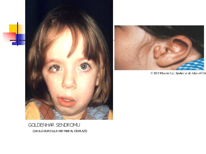 GOLDENHAR SENDROMU (OKULO-AURICULA-VERTABRAL DİSPLAZİ) GOLDENHAR SENDROMU (OKULO-AURICULA-VERTABRAL DİSPLAZİ)