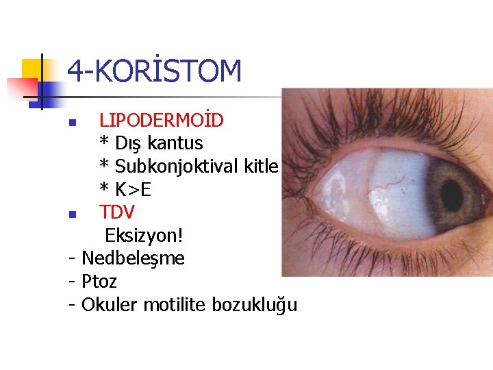 4 -KORİSTOM LIPODERMOİD * Dış kantus * Subkonjoktival kitle * K>E n TDV Eksizyon! 4 -KORİSTOM LIPODERMOİD * Dış kantus * Subkonjoktival kitle * K>E n TDV Eksizyon!