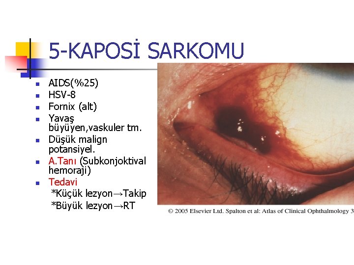 5 -KAPOSİ SARKOMU n n n n AIDS(%25) HSV-8 Fornix (alt) Yavaş büyüyen, vaskuler 5 -KAPOSİ SARKOMU n n n n AIDS(%25) HSV-8 Fornix (alt) Yavaş büyüyen, vaskuler