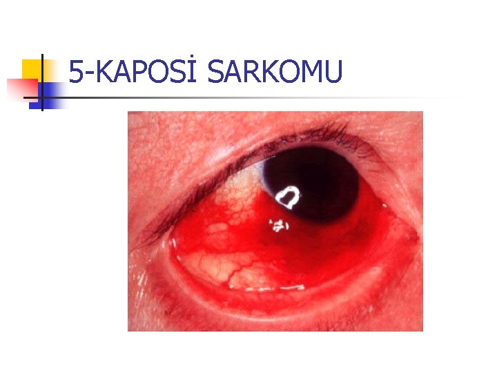 5 -KAPOSİ SARKOMU 5 -KAPOSİ SARKOMU