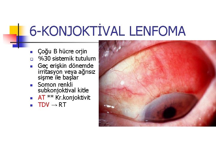 6 -KONJOKTİVAL LENFOMA n q n n Çoğu B hücre orjin %30 sistemik tutulum 6 -KONJOKTİVAL LENFOMA n q n n Çoğu B hücre orjin %30 sistemik tutulum