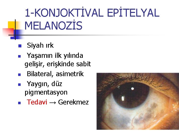 1 -KONJOKTİVAL EPİTELYAL MELANOZİS n n n Siyah ırk Yaşamın ilk yılında gelişir, erişkinde 1 -KONJOKTİVAL EPİTELYAL MELANOZİS n n n Siyah ırk Yaşamın ilk yılında gelişir, erişkinde