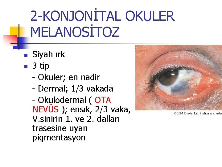 2 -KONJONİTAL OKULER MELANOSİTOZ n n Siyah ırk 3 tip - Okuler; en nadir 2 -KONJONİTAL OKULER MELANOSİTOZ n n Siyah ırk 3 tip - Okuler; en nadir