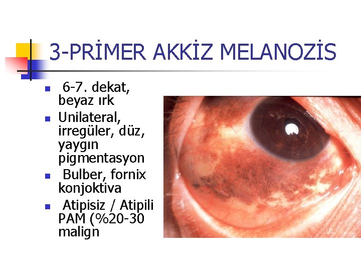 3 -PRİMER AKKİZ MELANOZİS n n 6 -7. dekat, beyaz ırk Unilateral, irregüler, düz, 3 -PRİMER AKKİZ MELANOZİS n n 6 -7. dekat, beyaz ırk Unilateral, irregüler, düz,