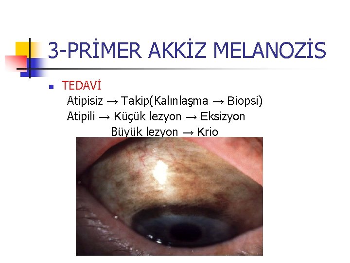 3 -PRİMER AKKİZ MELANOZİS n TEDAVİ Atipisiz → Takip(Kalınlaşma → Biopsi) Atipili → Küçük 3 -PRİMER AKKİZ MELANOZİS n TEDAVİ Atipisiz → Takip(Kalınlaşma → Biopsi) Atipili → Küçük
