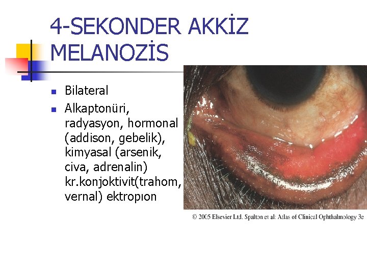4 -SEKONDER AKKİZ MELANOZİS n n Bilateral Alkaptonüri, radyasyon, hormonal (addison, gebelik), kimyasal (arsenik, 4 -SEKONDER AKKİZ MELANOZİS n n Bilateral Alkaptonüri, radyasyon, hormonal (addison, gebelik), kimyasal (arsenik,