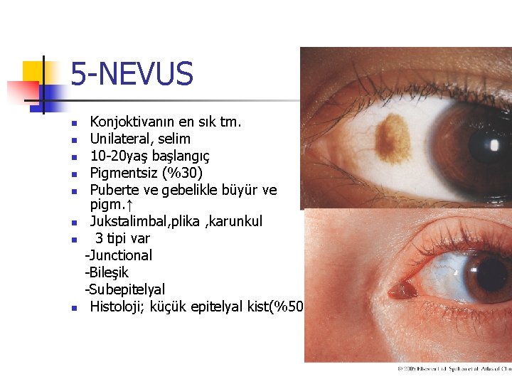 5 -NEVUS n n n n Konjoktivanın en sık tm. Unilateral, selim 10 -20 5 -NEVUS n n n n Konjoktivanın en sık tm. Unilateral, selim 10 -20