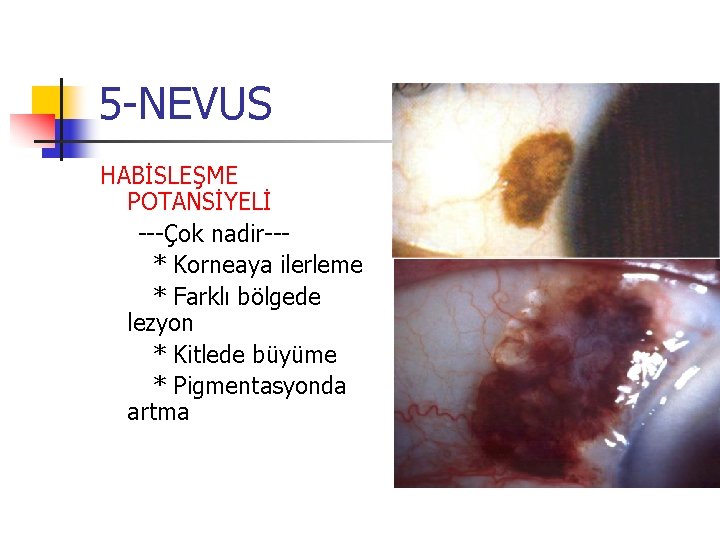 5 -NEVUS HABİSLEŞME POTANSİYELİ ---Çok nadir--* Korneaya ilerleme * Farklı bölgede lezyon * Kitlede 5 -NEVUS HABİSLEŞME POTANSİYELİ ---Çok nadir--* Korneaya ilerleme * Farklı bölgede lezyon * Kitlede