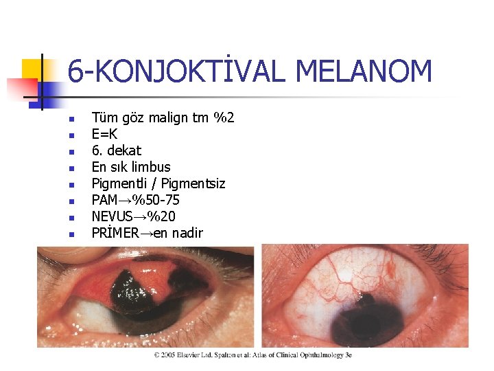 6 -KONJOKTİVAL MELANOM n n n n Tüm göz malign tm %2 E=K 6. 6 -KONJOKTİVAL MELANOM n n n n Tüm göz malign tm %2 E=K 6.