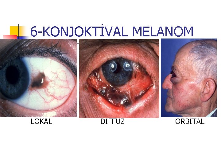 6 -KONJOKTİVAL MELANOM LOKAL DİFFUZ ORBİTAL 6 -KONJOKTİVAL MELANOM LOKAL DİFFUZ ORBİTAL