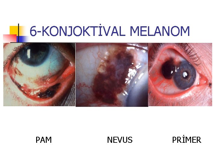 6 -KONJOKTİVAL MELANOM PAM NEVUS PRİMER 6 -KONJOKTİVAL MELANOM PAM NEVUS PRİMER