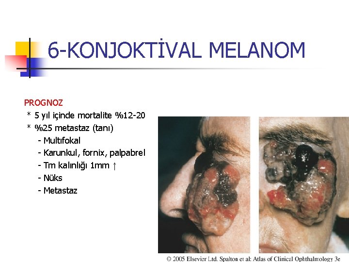 6 -KONJOKTİVAL MELANOM PROGNOZ * 5 yıl içinde mortalite %12 -20 * %25 metastaz 6 -KONJOKTİVAL MELANOM PROGNOZ * 5 yıl içinde mortalite %12 -20 * %25 metastaz