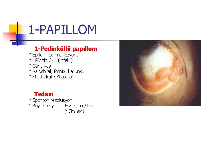 1 -PAPILLOM * * * 1 -Pedinküllü papıllom Epitelin bening lezyonu HPV tip 6 1 -PAPILLOM * * * 1 -Pedinküllü papıllom Epitelin bening lezyonu HPV tip 6