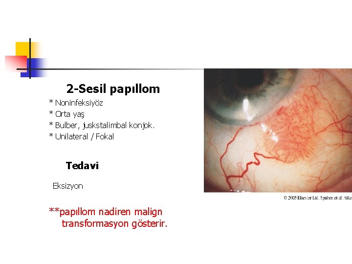 2 -Sesil papıllom * * Noninfeksiyöz Orta yaş Bulber, juskstalimbal konjok. Unilateral / Fokal 2 -Sesil papıllom * * Noninfeksiyöz Orta yaş Bulber, juskstalimbal konjok. Unilateral / Fokal