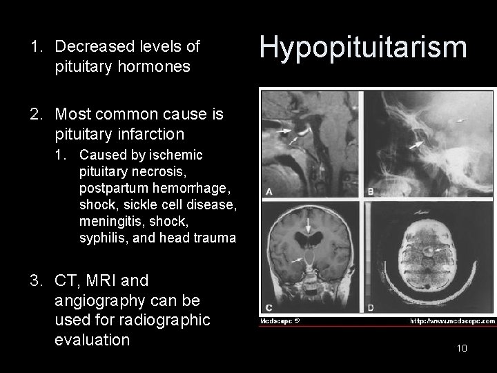 1. Decreased levels of pituitary hormones Hypopituitarism 2. Most common cause is pituitary infarction