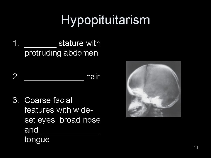 Hypopituitarism 1. _______ stature with protruding abdomen 2. _______ hair 3. Coarse facial features