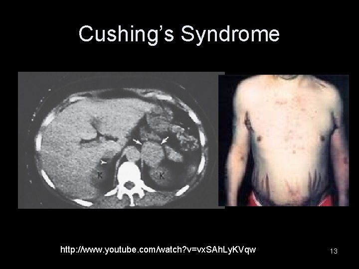 Cushing’s Syndrome http: //www. youtube. com/watch? v=vx. SAh. Ly. KVqw 13 