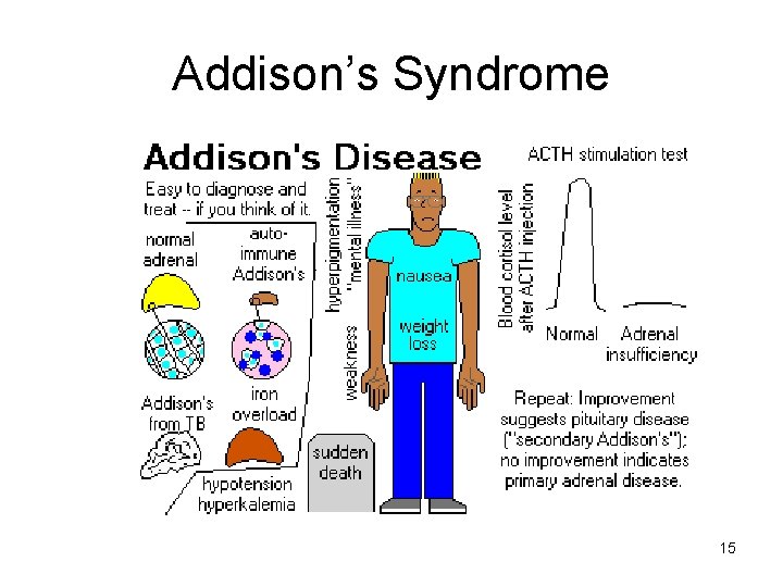 Addison’s Syndrome 15 