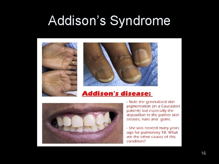 Addison’s Syndrome 16 