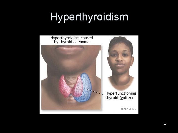 Hyperthyroidism 24 