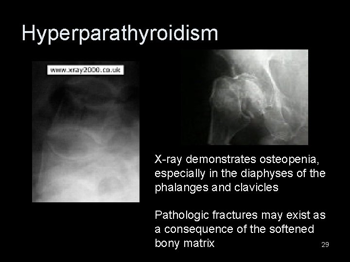 Hyperparathyroidism X-ray demonstrates osteopenia, especially in the diaphyses of the phalanges and clavicles Pathologic