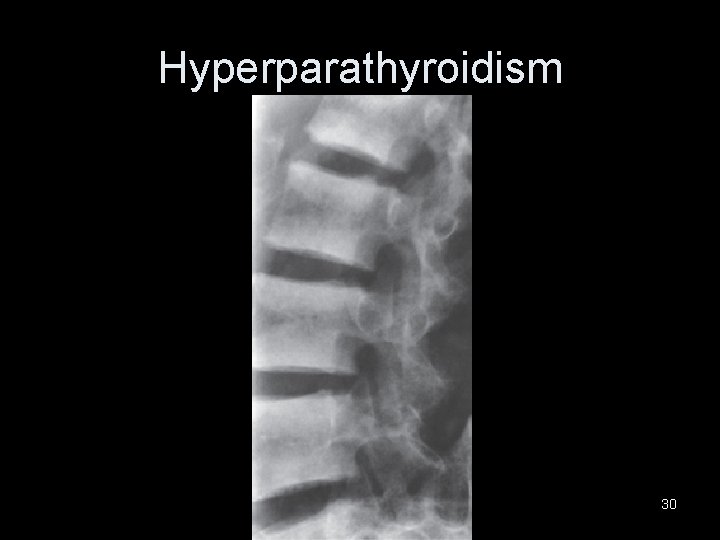 Hyperparathyroidism 30 