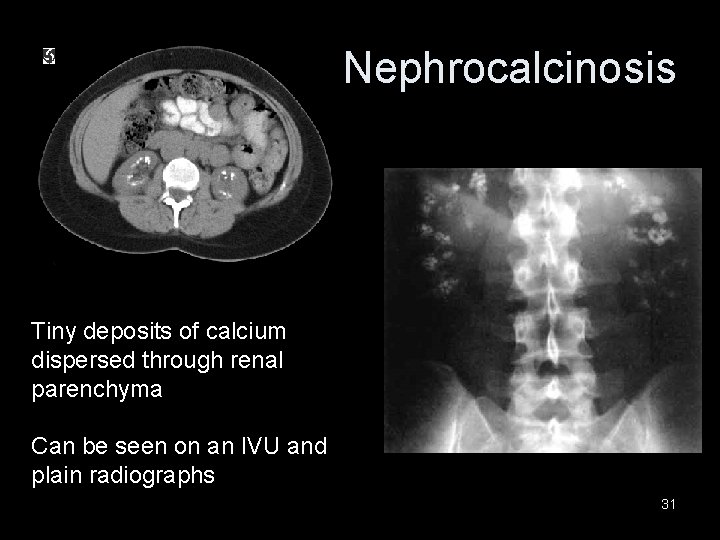 Nephrocalcinosis Tiny deposits of calcium dispersed through renal parenchyma Can be seen on an