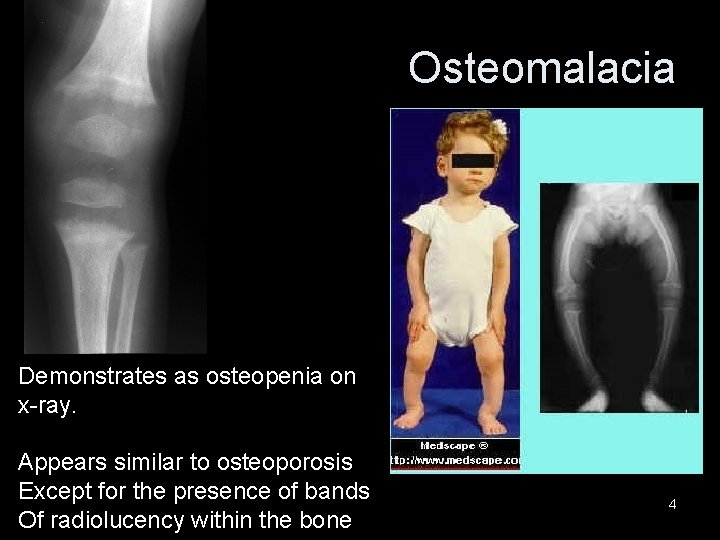 Osteomalacia Demonstrates as osteopenia on x-ray. Appears similar to osteoporosis Except for the presence