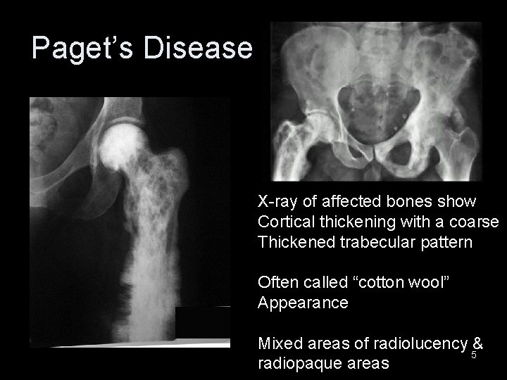 Paget’s Disease X-ray of affected bones show Cortical thickening with a coarse Thickened trabecular