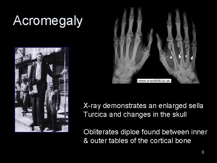 Acromegaly X-ray demonstrates an enlarged sella Turcica and changes in the skull Obliterates diploe