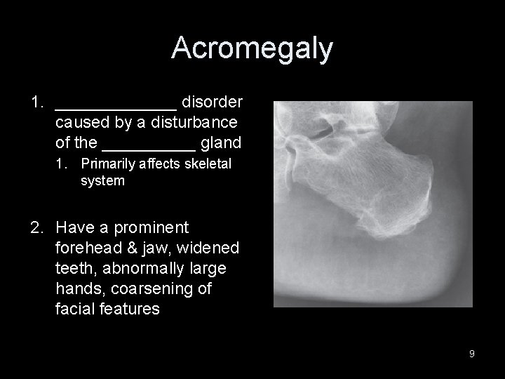Acromegaly 1. _______ disorder caused by a disturbance of the _____ gland 1. Primarily
