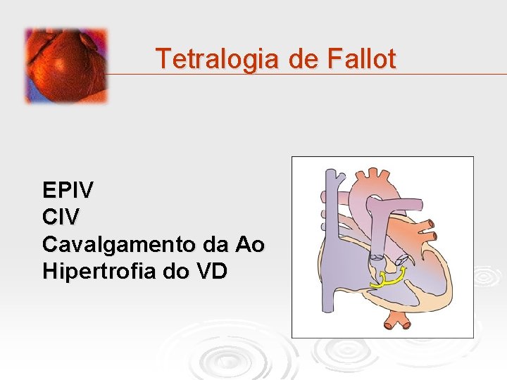 Tetralogia de Fallot EPIV Cavalgamento da Ao Hipertrofia do VD 