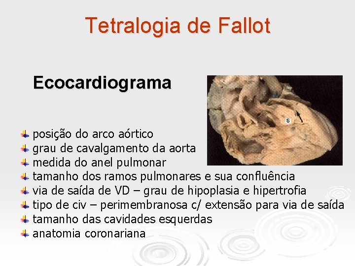 Tetralogia de Fallot Ecocardiograma posição do arco aórtico grau de cavalgamento da aorta medida