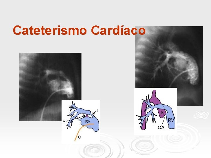 Cateterismo Cardíaco 