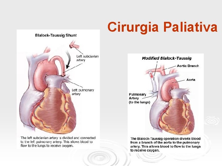 Cirurgia Paliativa 