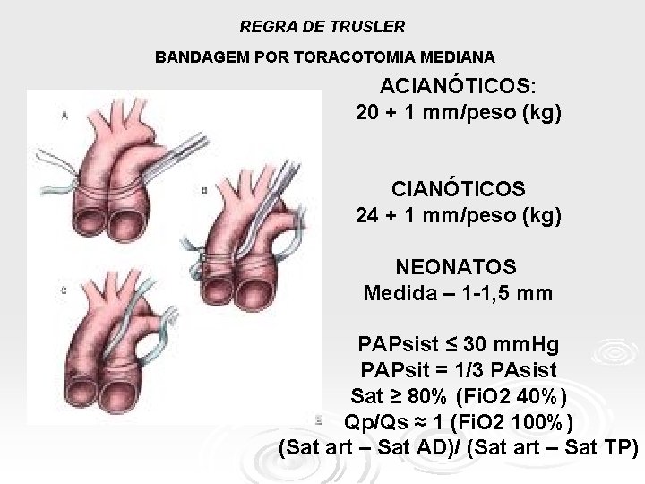 REGRA DE TRUSLER BANDAGEM POR TORACOTOMIA MEDIANA ACIANÓTICOS: 20 + 1 mm/peso (kg) CIANÓTICOS