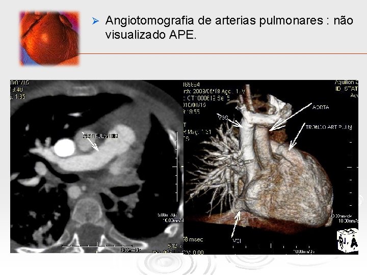 Ø Angiotomografia de arterias pulmonares : não visualizado APE. 