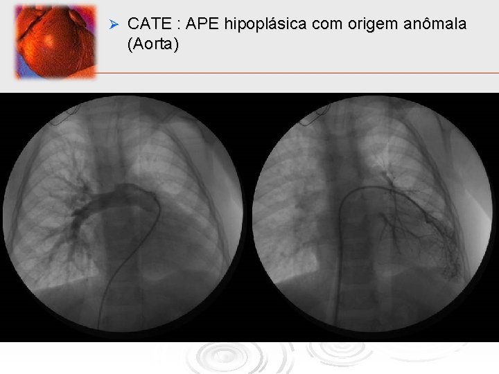 Ø CATE : APE hipoplásica com origem anômala (Aorta) 