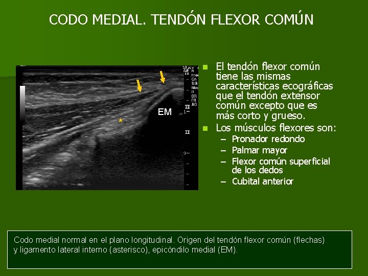 CODO MEDIAL. TENDÓN FLEXOR COMÚN El tendón flexor común tiene las mismas características ecográficas