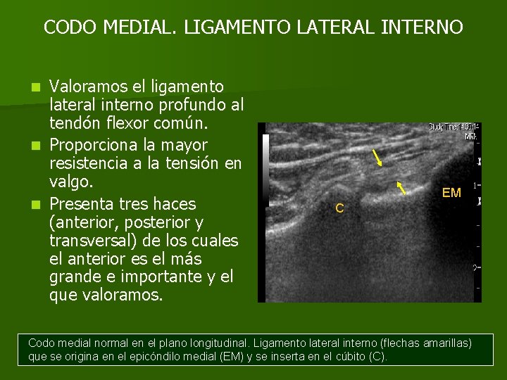 CODO MEDIAL. LIGAMENTO LATERAL INTERNO Valoramos el ligamento lateral interno profundo al tendón flexor