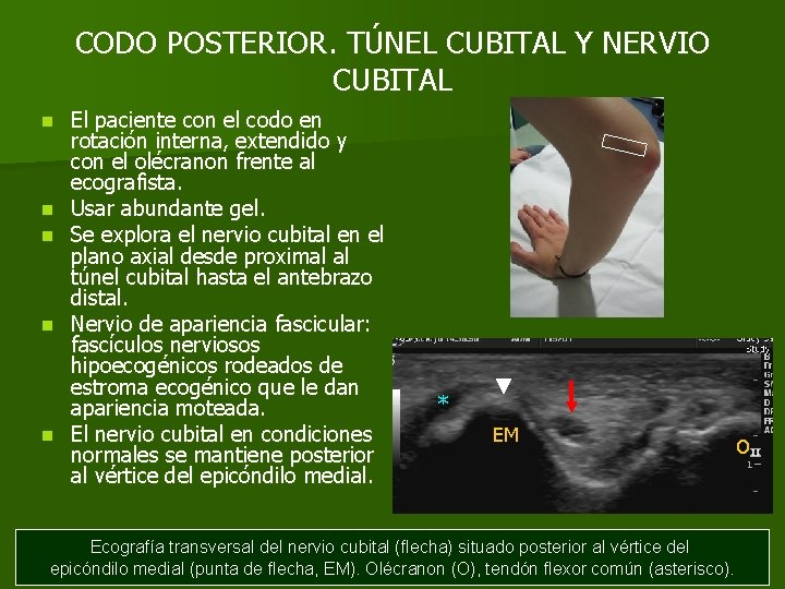 CODO POSTERIOR. TÚNEL CUBITAL Y NERVIO CUBITAL n n n El paciente con el