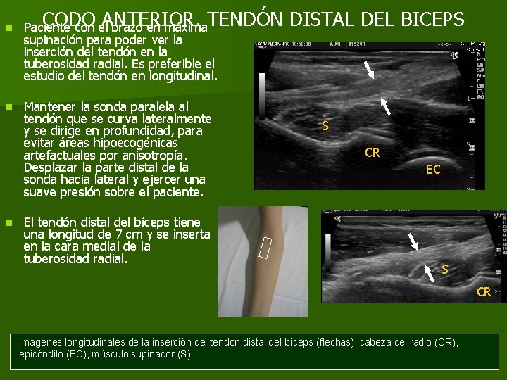 n n n CODO ANTERIOR. Paciente con el brazo en máxima. TENDÓN supinación para