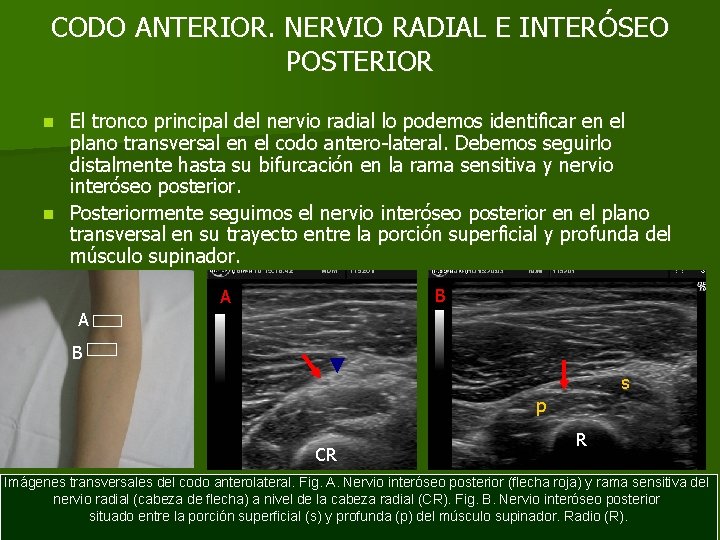 CODO ANTERIOR. NERVIO RADIAL E INTERÓSEO POSTERIOR El tronco principal del nervio radial lo
