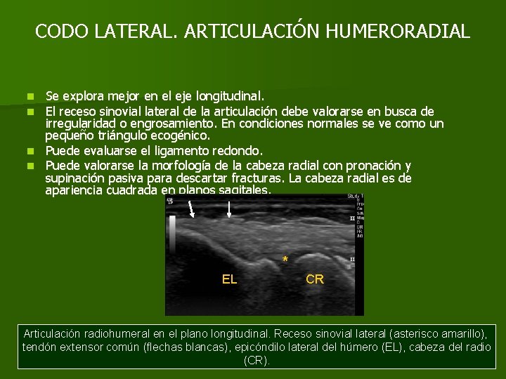 CODO LATERAL. ARTICULACIÓN HUMERORADIAL Se explora mejor en el eje longitudinal. El receso sinovial