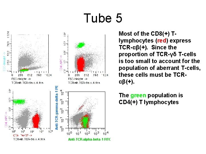 Tube 5 Most of the CD 8(+) Tlymphocytes (red) express TCR-αβ(+). Since the proportion