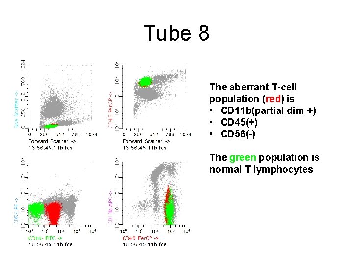 Tube 8 The aberrant T-cell population (red) is • CD 11 b(partial dim +)