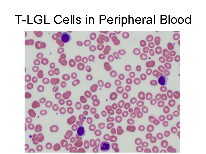 T-LGL Cells in Peripheral Blood 
