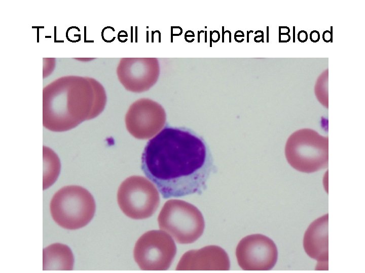T-LGL Cell in Peripheral Blood 